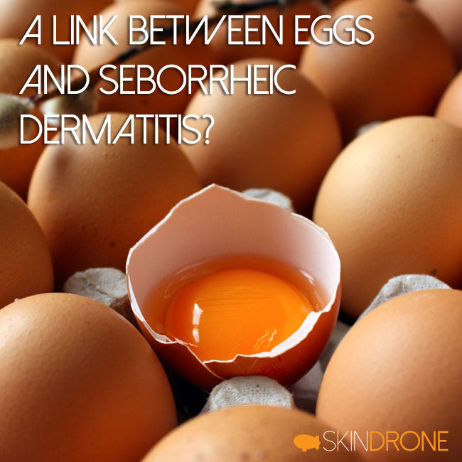 A link between seborrheic dermatitis and eggs?