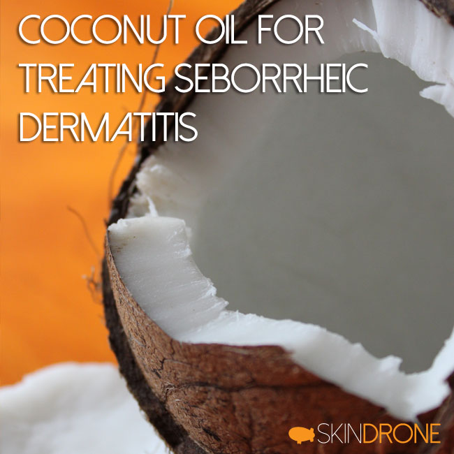 Treating Seborrheic Dermatitis with Coconut Oil Cover Image