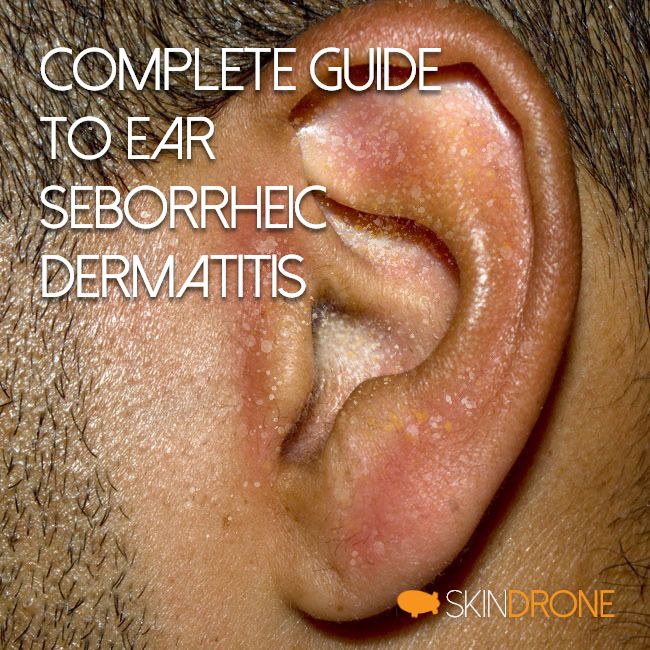 Seborrheic Dermatitis of the Ears - Basics, Diagnosis, and Treatment - Cover Photo Featuring Ear and Text