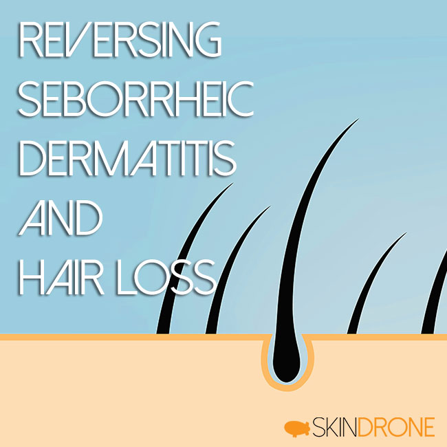Reversing Seborrheic Dermatitis and Hair Loss – SkinDrone