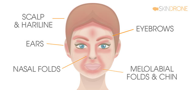 Facial Areas Most Commonly Affected by Seborrheic Dermatitis