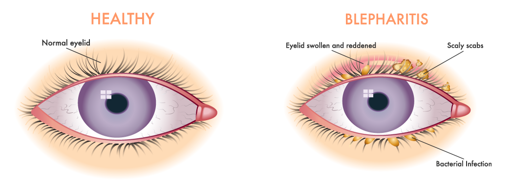 Dealing With Seborrheic Dermatitis Effecting The Eyelids Skindrone 