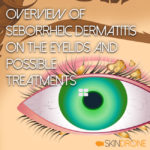 Dealing with Seborrheic Dermatitis Effecting the Eyelids – SkinDrone