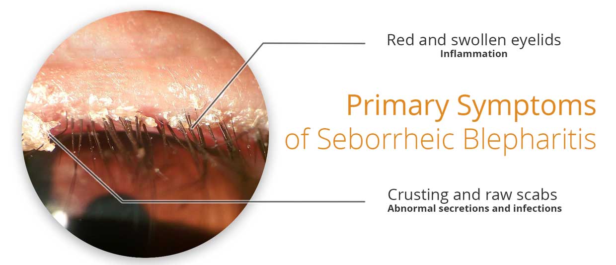 seborrheic blepharitis treatment