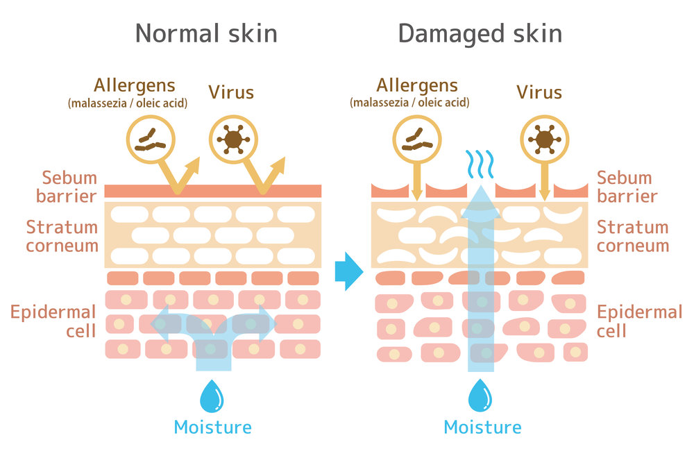 Dandruff Vs Seborrheic Dermatitis