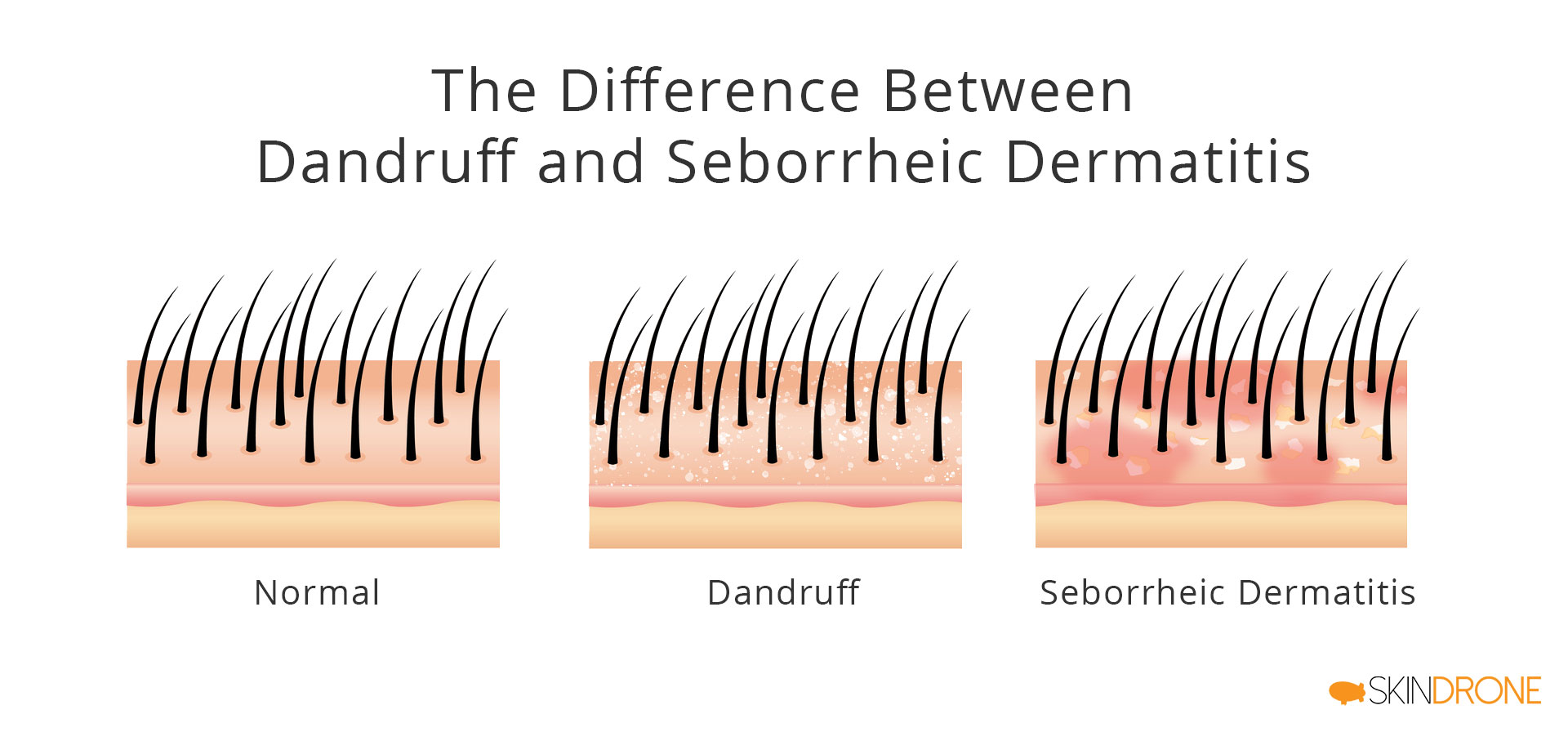 Seborrheic Dermatitis On The Scalp The Complete Guide – Skindrone