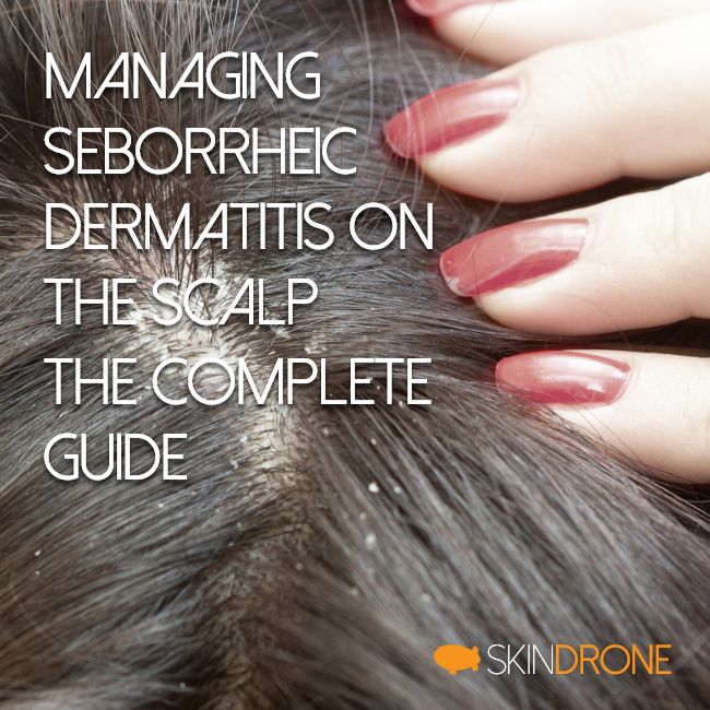 Managing Seborrheic Dermatitis of the scalp - Cover photo - Women touch irritated scalp
