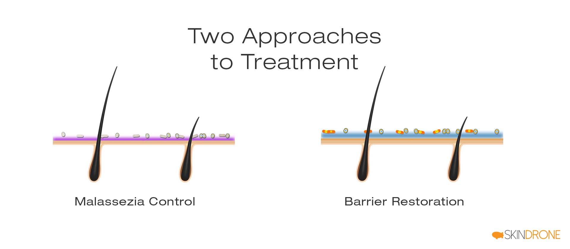 Two primary treatment approaches to scalp seborrheic dermatitis - malassezia control and barrier restoration