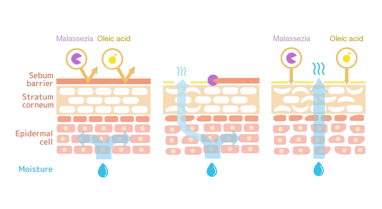 Diagram of how malassezia degrade the sebum layer and irritate the skin