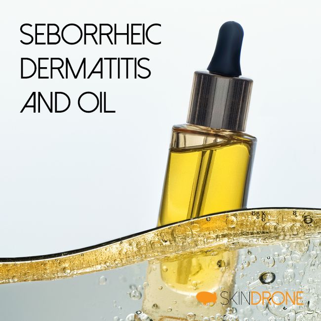 Cover photo for Seborrheic Dermatitis and Oil article