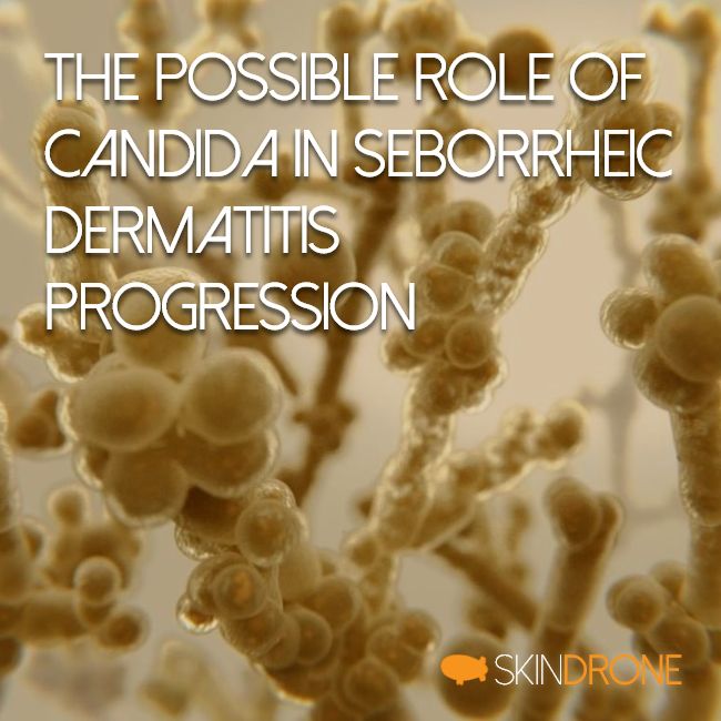 The Possible Role Of Candida In Seborrheic Dermatitis Progression