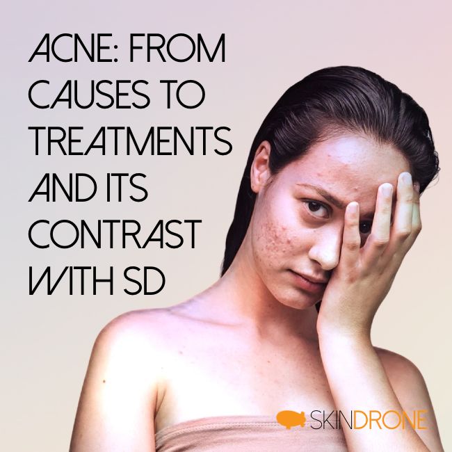 Acne vs. Seborrheic Dermatitis - Understanding Causes, Treatments, and Impact