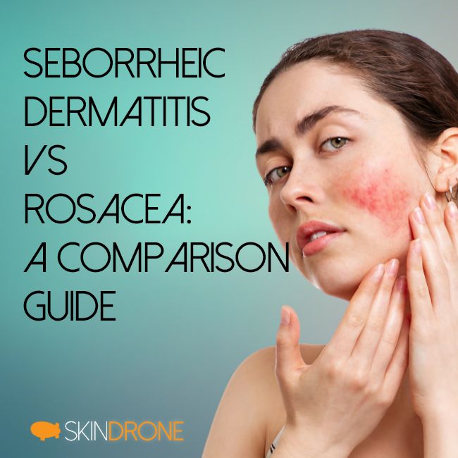 A photo of a person highlighting their facial rosacea symptoms in the bottom right corner. The article title "Seborrheic Dermatitis vs Rosacea: A Comparison Guide" appears in the top left.