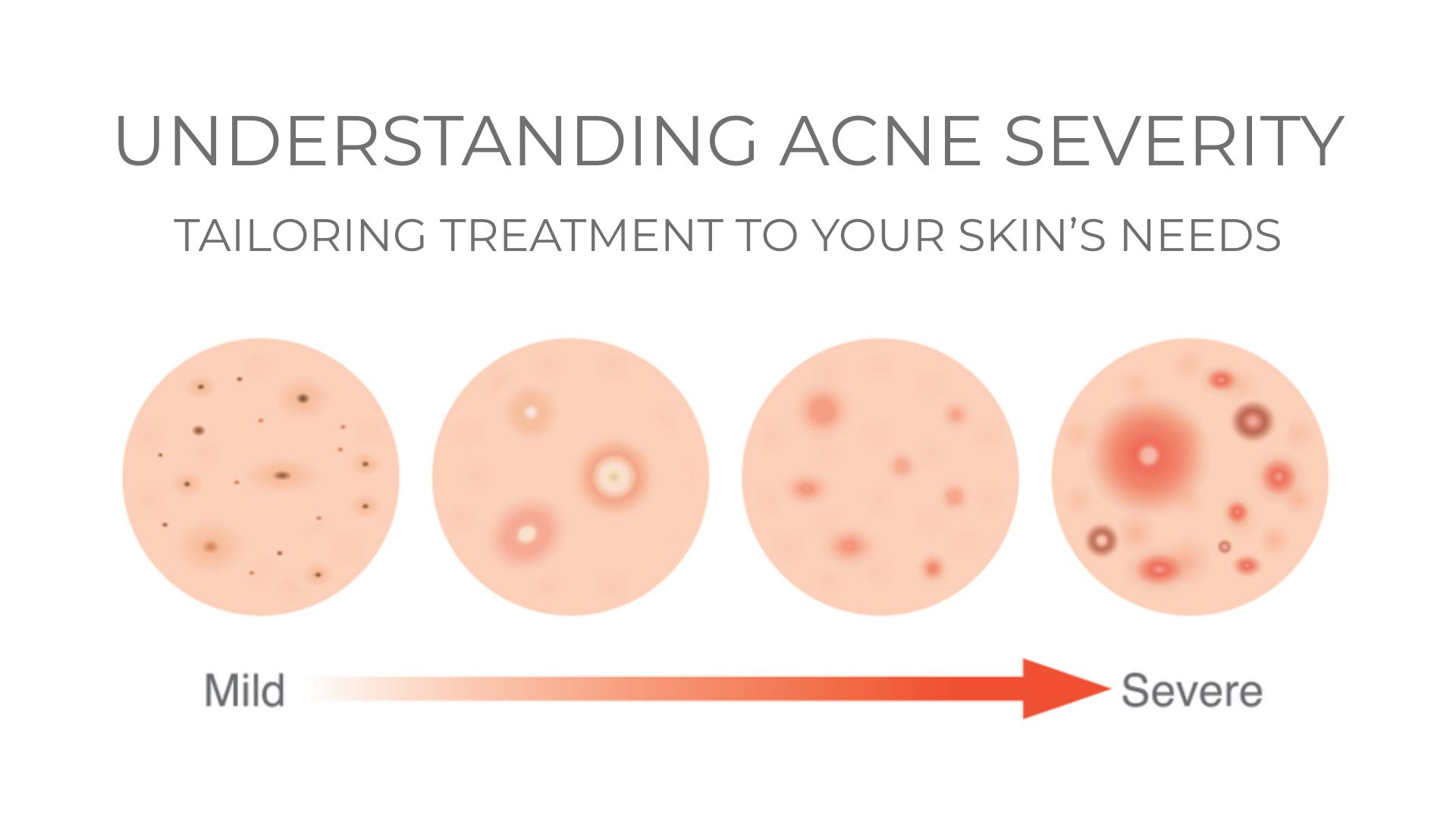 Diagram of acne severity scale