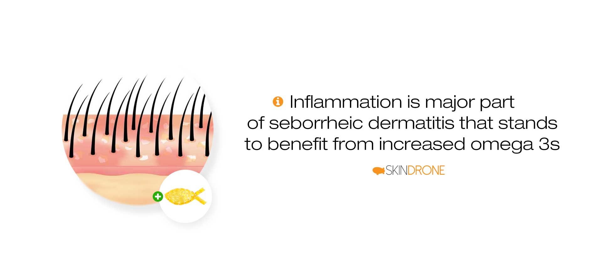 Banner stating that inflammation is a major part of seborrheic dermatitis that stands to benefit from increased omega 3s - image shows a diagram of seborrheic dermatitis on the scalp and the inflammation present together with a small circle that contains fish oil capsules in the shape of a small fish