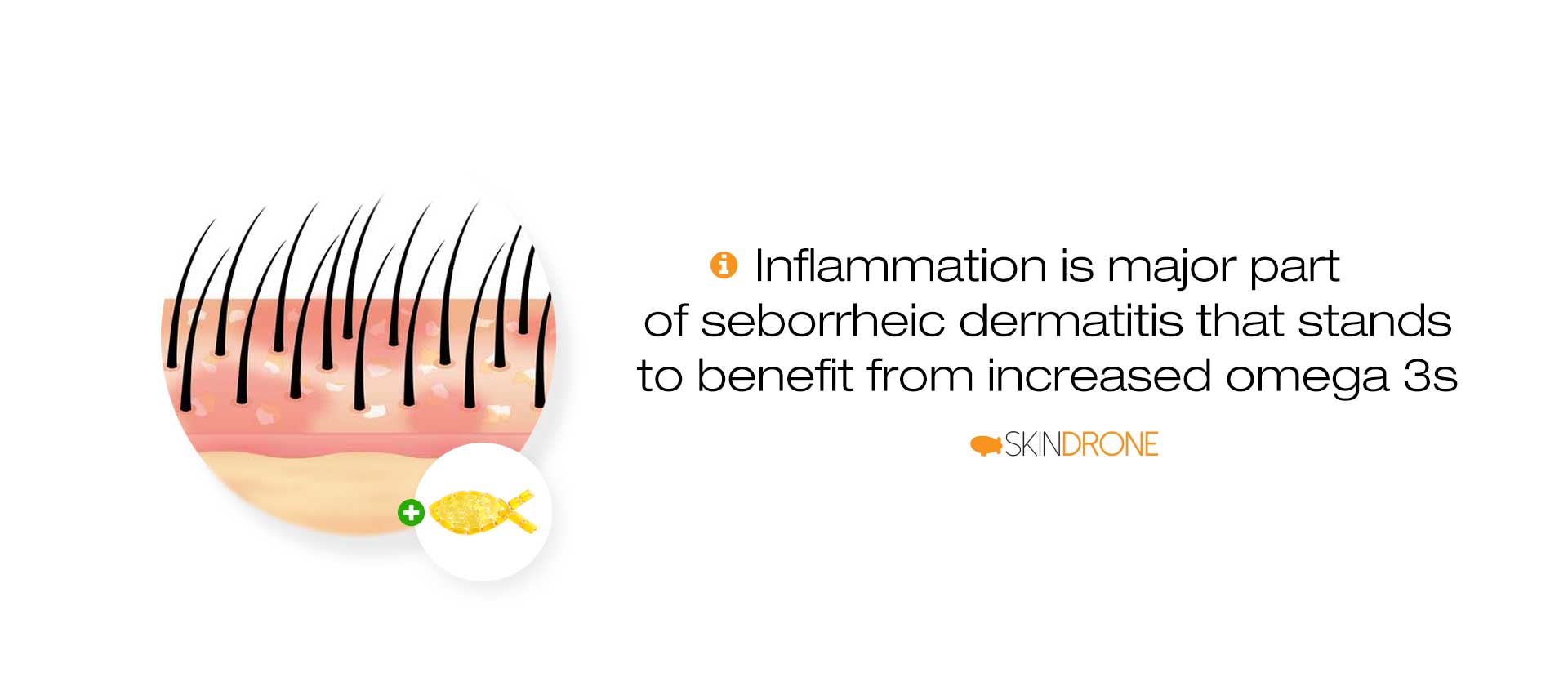 Banner que afirma que la inflamación es una parte importante de la dermatitis seborreica que podría beneficiarse de un mayor consumo de omega 3: la imagen muestra un diagrama de la dermatitis seborreica en el cuero cabelludo y la inflamación presente junto con un pequeño círculo que contiene cápsulas de aceite de pescado en forma de un pequeño pez